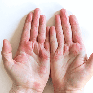 How Red Light Therapy Can Help With Eczema