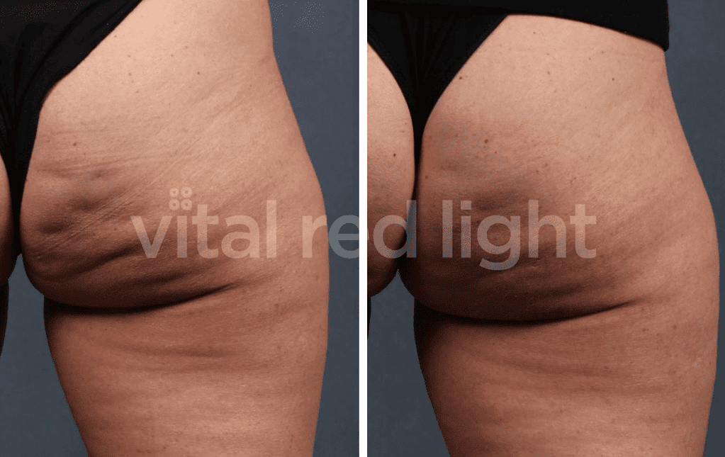 Before and after red light therapy