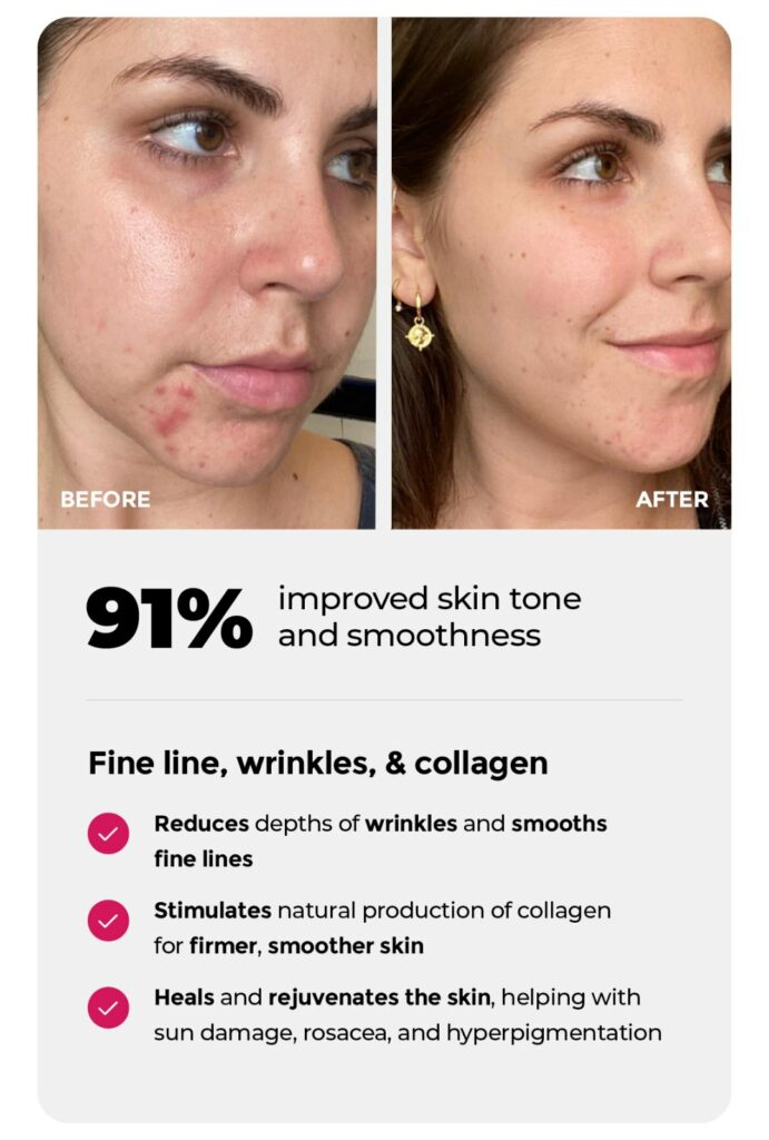 improved skin tone with red light therapy