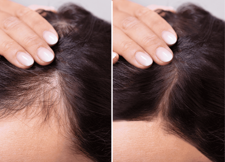 Before and after comparison of a person's scalp, showcasing hair thinning on the left and fuller hair on the right, with a hand holding back the hair in both images. This impressive transformation demonstrates how red light therapy works wonders for enhancing hair growth and overall scalp health.