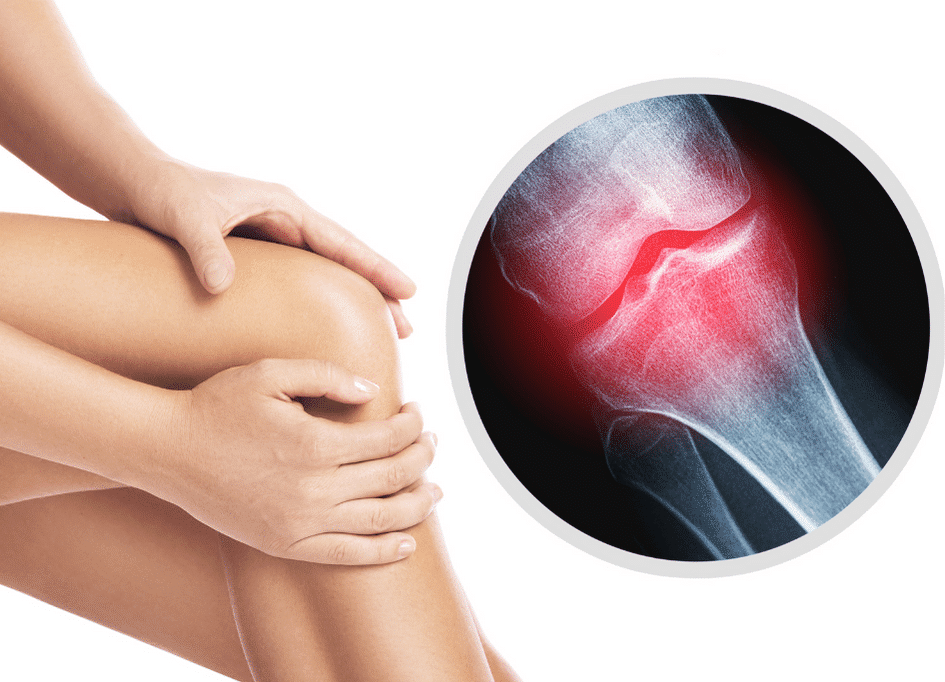 A person clutches their knee, with a highlighted X-ray revealing inflammation in the joint, pondering how red light therapy works to potentially alleviate their discomfort.